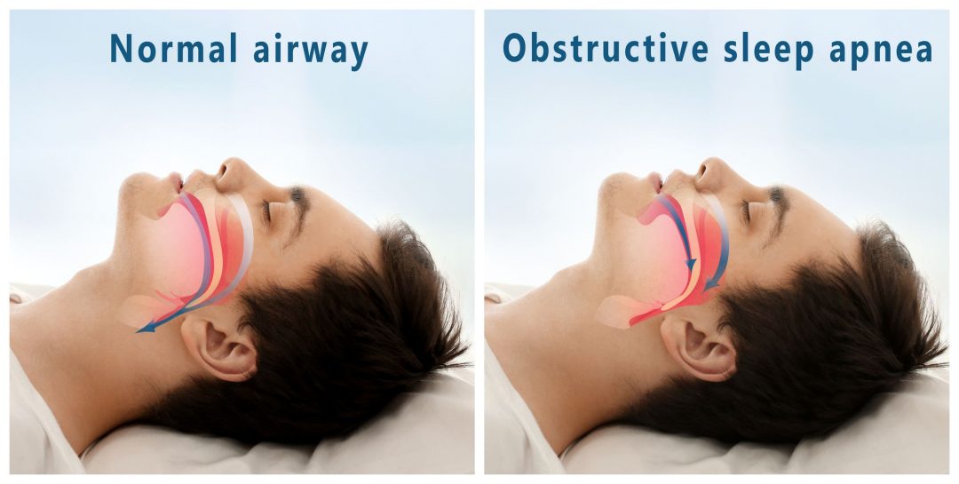 Mouth Breathing Causes Treatments And Consequences Buteyko Clinic