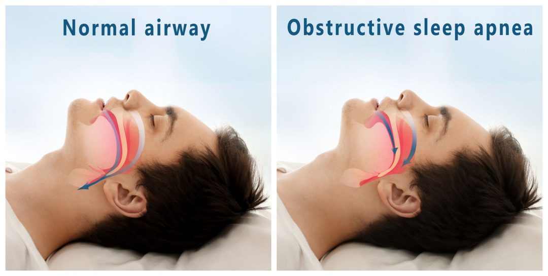 Mouth Breathing Causes, Treatments And Consequences Buteyko Clinic